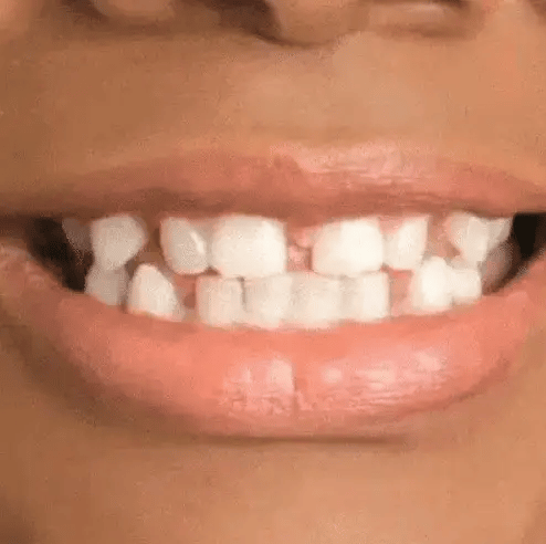 Carillas Dentales Premium ® Snap-On Smile - Perfecto para muecos & dientes amarillos